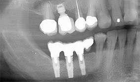 Implantat