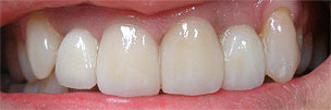 Veneer